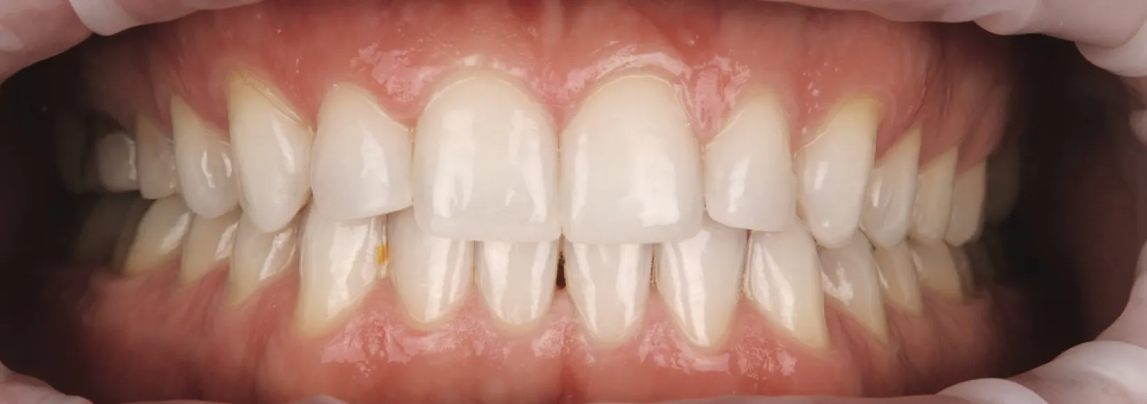 Vóór de behandeling: Rechte beet met ruimte tussen de tanden en diastema