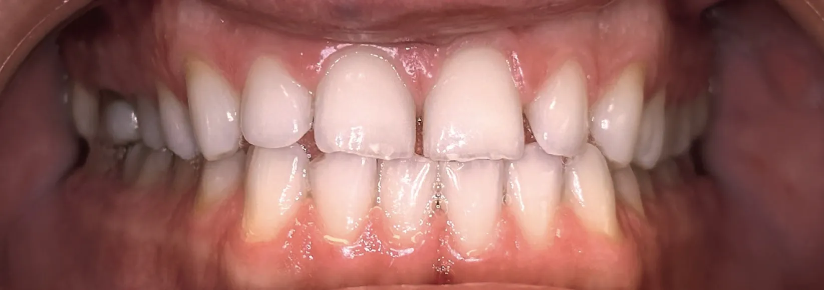 Na de behandeling: Rechte beet met ruimte tussen de tanden en diastema