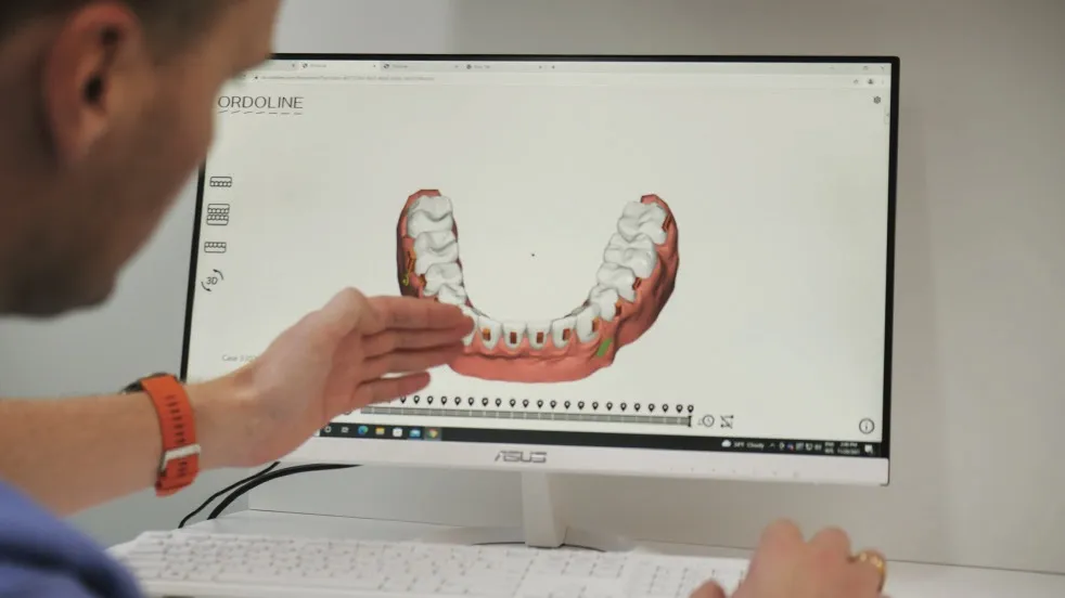 Het 3D-behandelplan van de aligners op een computerscherm